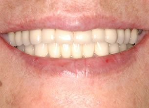 症例2 : 上顎無菌顎・下顎部分欠損症例