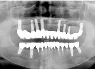 症例2 : 上顎無菌顎・下顎部分欠損症例