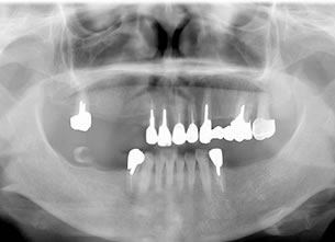 症例3 : 上下顎部分欠損症例
