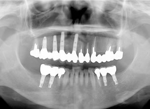 症例3 : 上下顎部分欠損症例